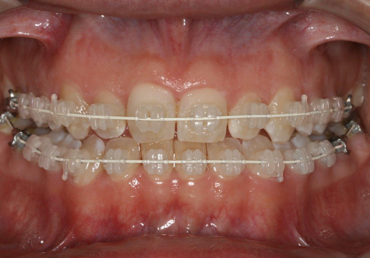 hvite klosser tannregulering