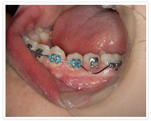 løs bøyle tannregulering barn
