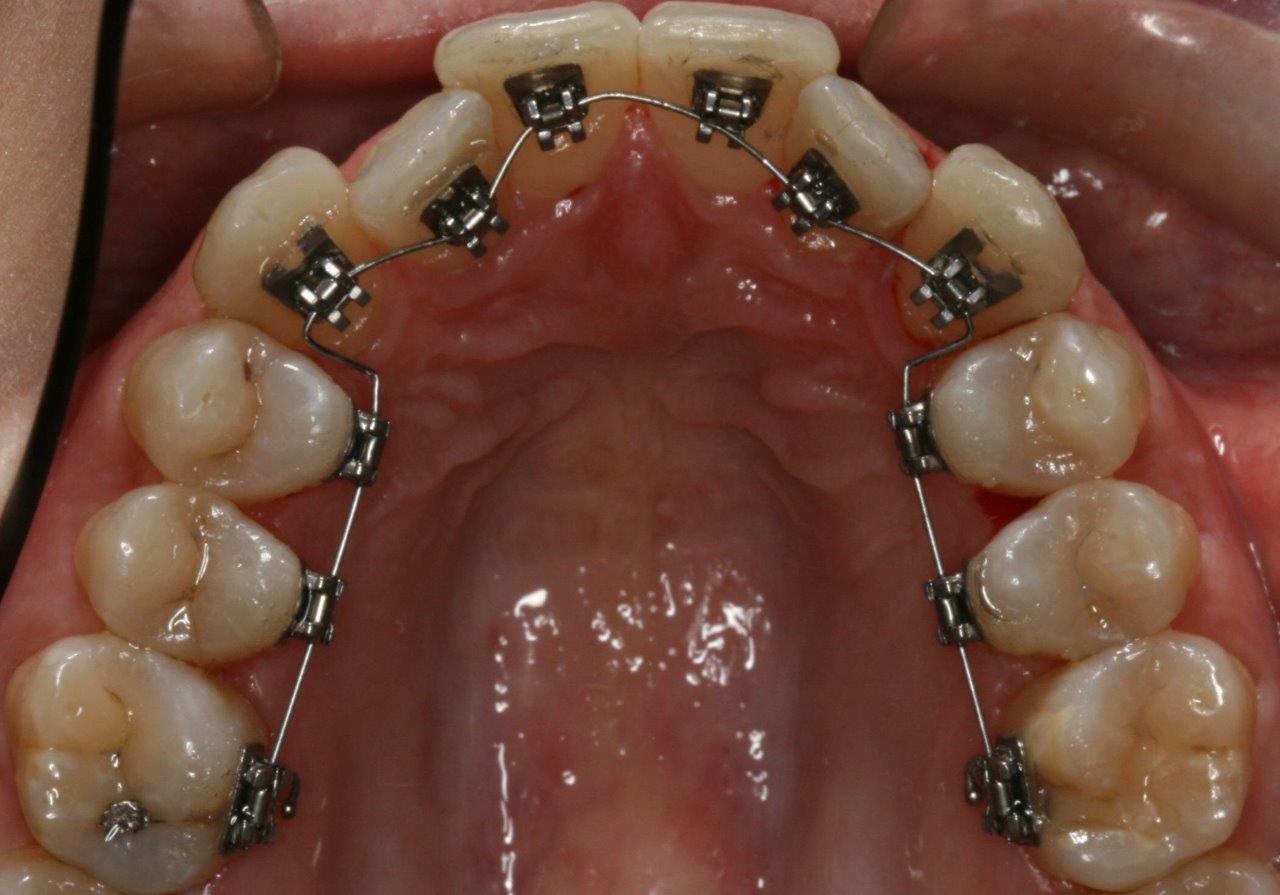 Klosser bak tennene