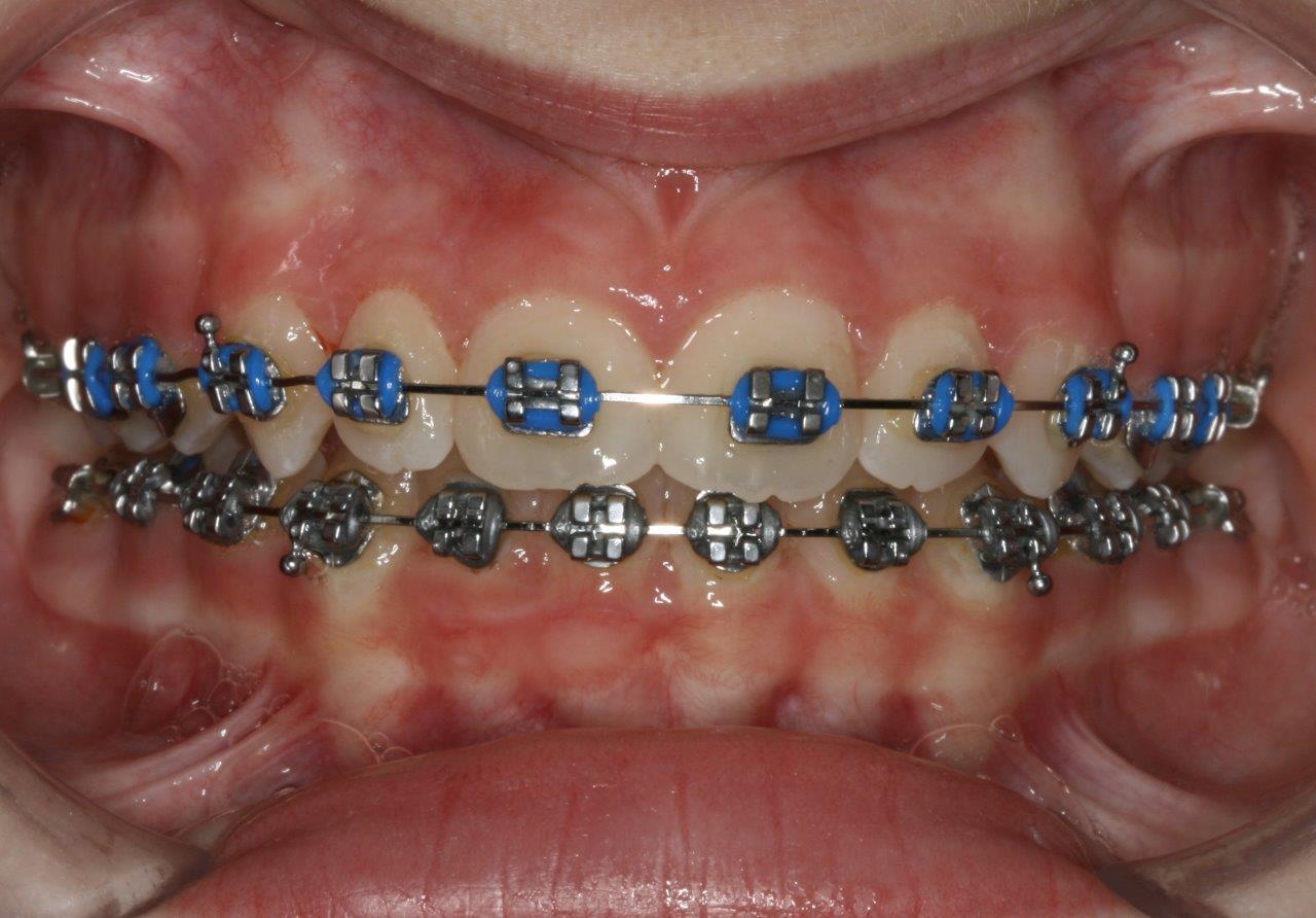 tannregulering med blå klosser