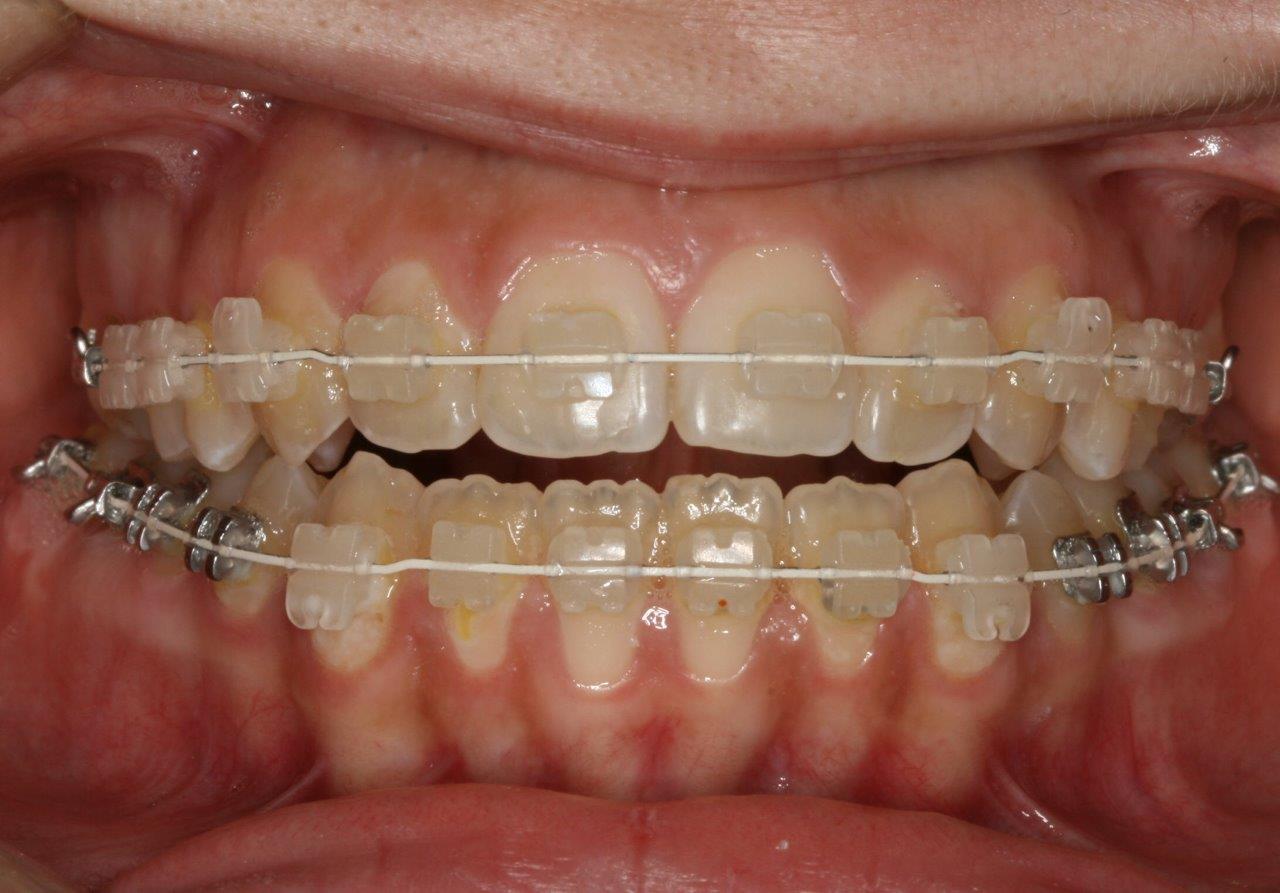 tannregulering med gjennomsiktige klosser