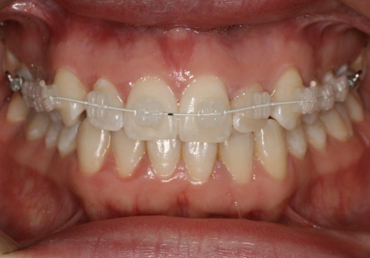 tannregulering gjennomsiktig kloss