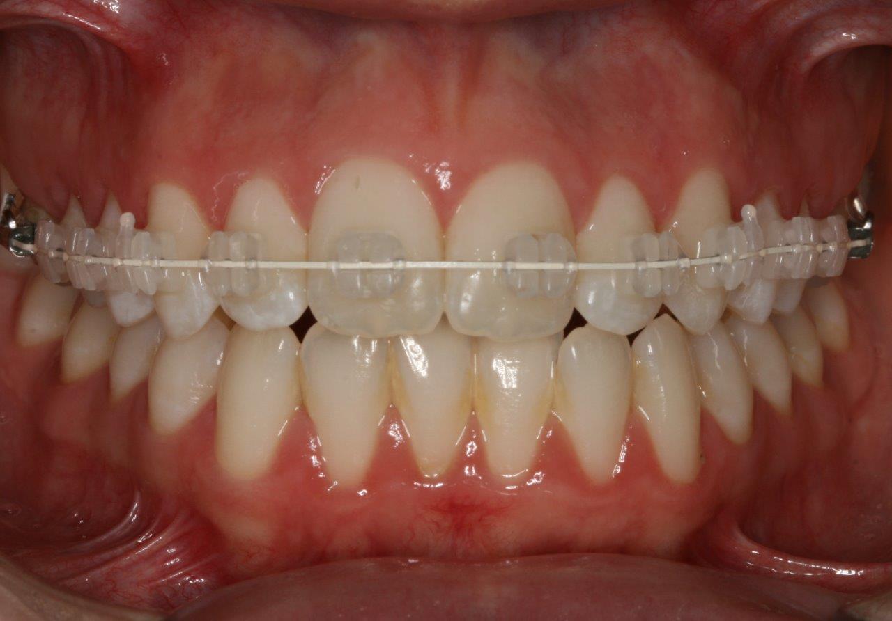 tannregulering med hvite klosser