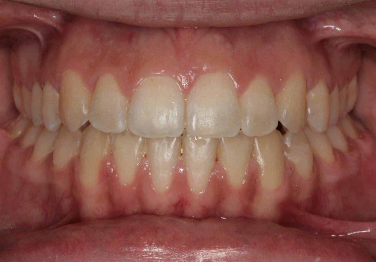 resultat av tannregulering