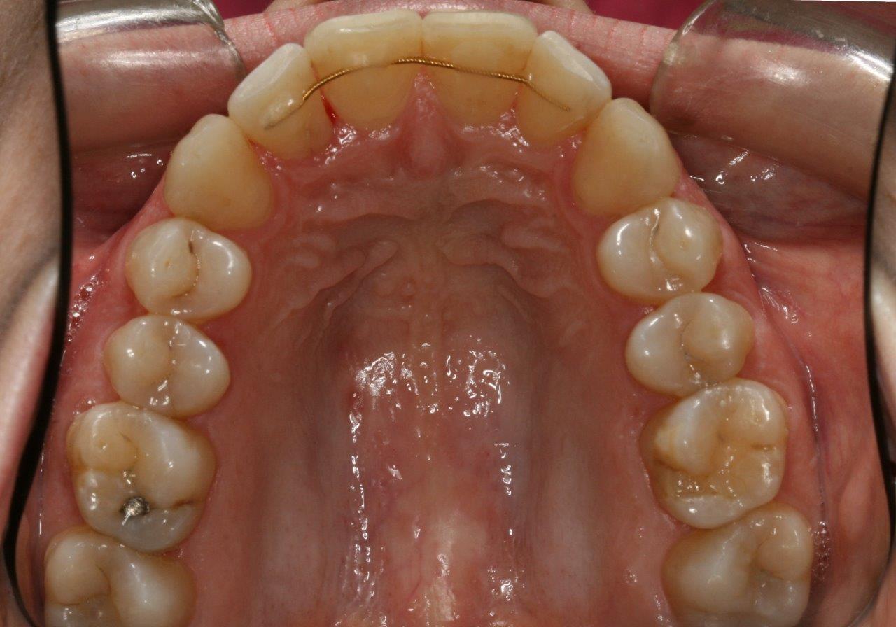 tannregulering bakside av tennene