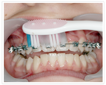puss av tannregulering