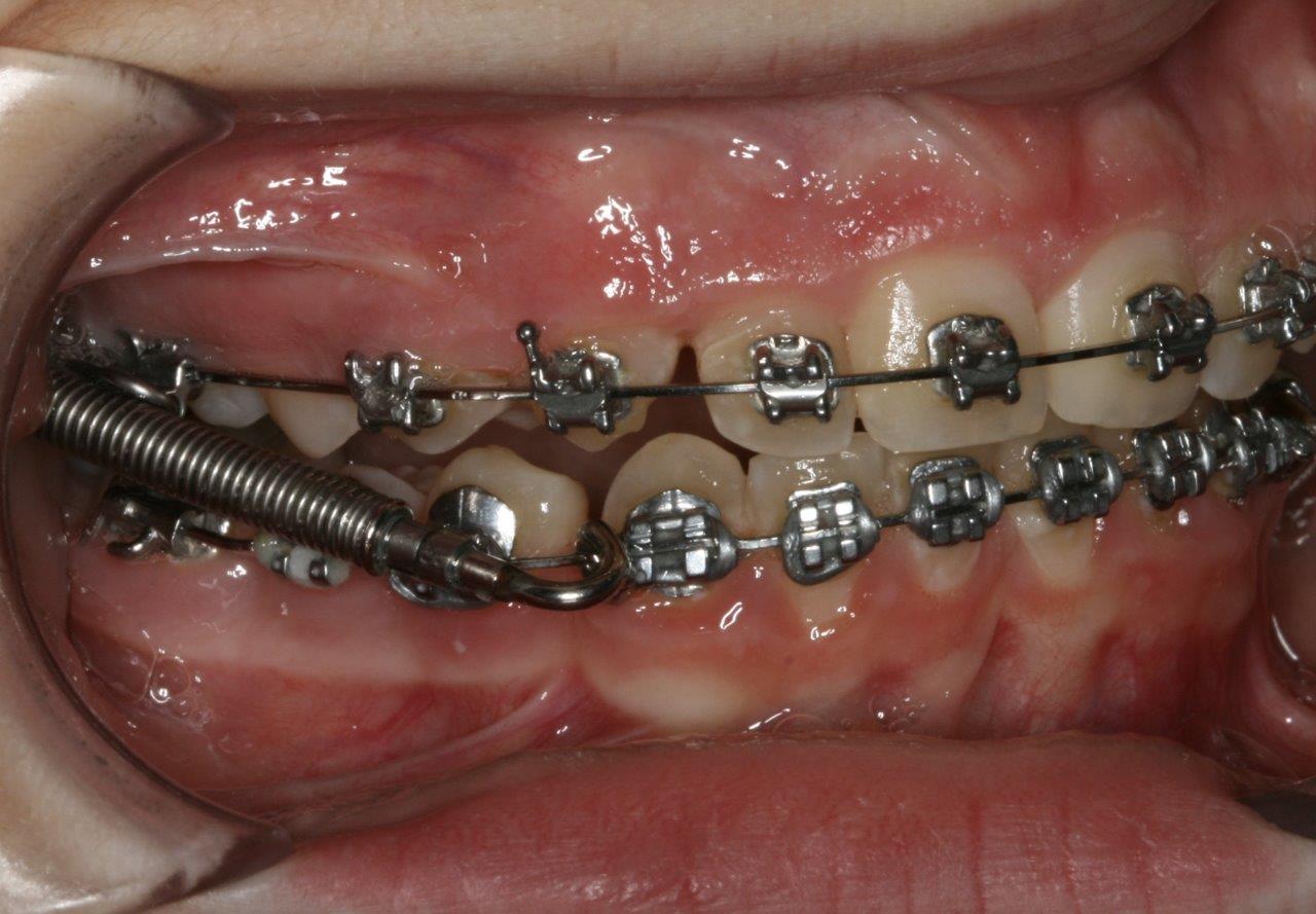 tenner med tannregulering