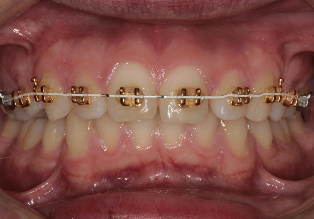 tannregulering med klosser